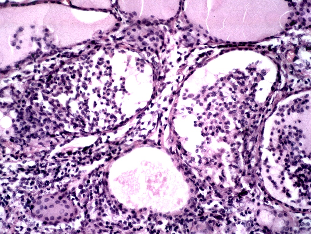 Pathology Outlines Hashimoto thyroiditis